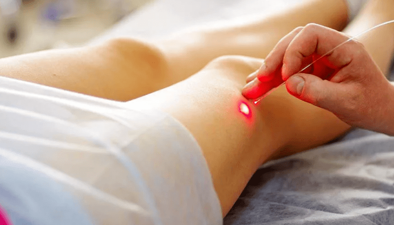 Laserowe krzepnięcie żylaków