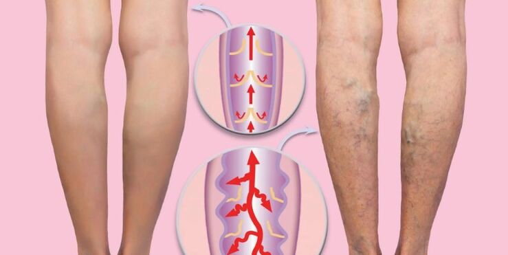 zdrowe i żylaki na nodze